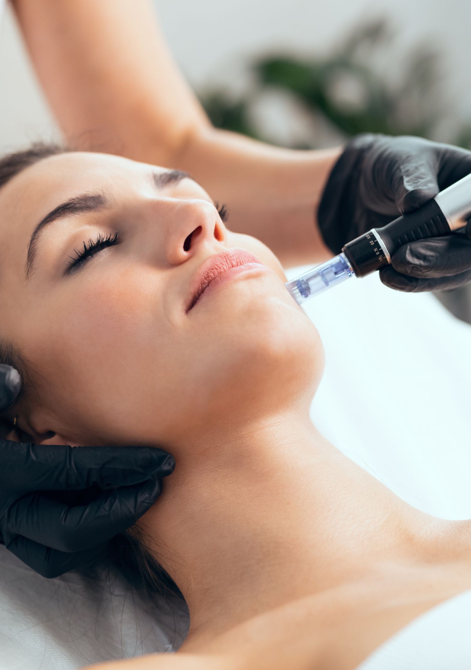 Microneedling